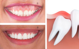 tieu-phau-nho-rang-khon-cuoi-ho-nuou-dieu-tri-cuoi-ho-nuou-uy-tin-quan-1