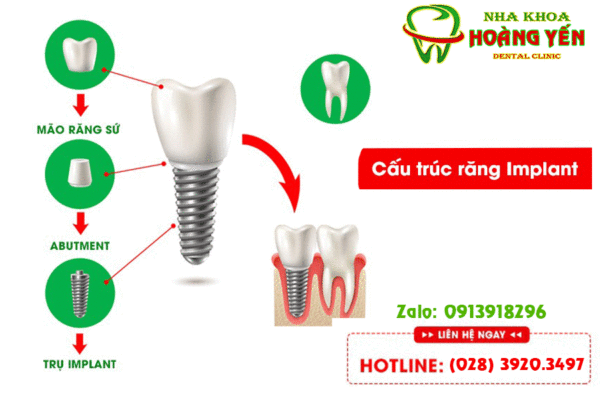 IMPLANT NHAKHOAHOANGYEN
