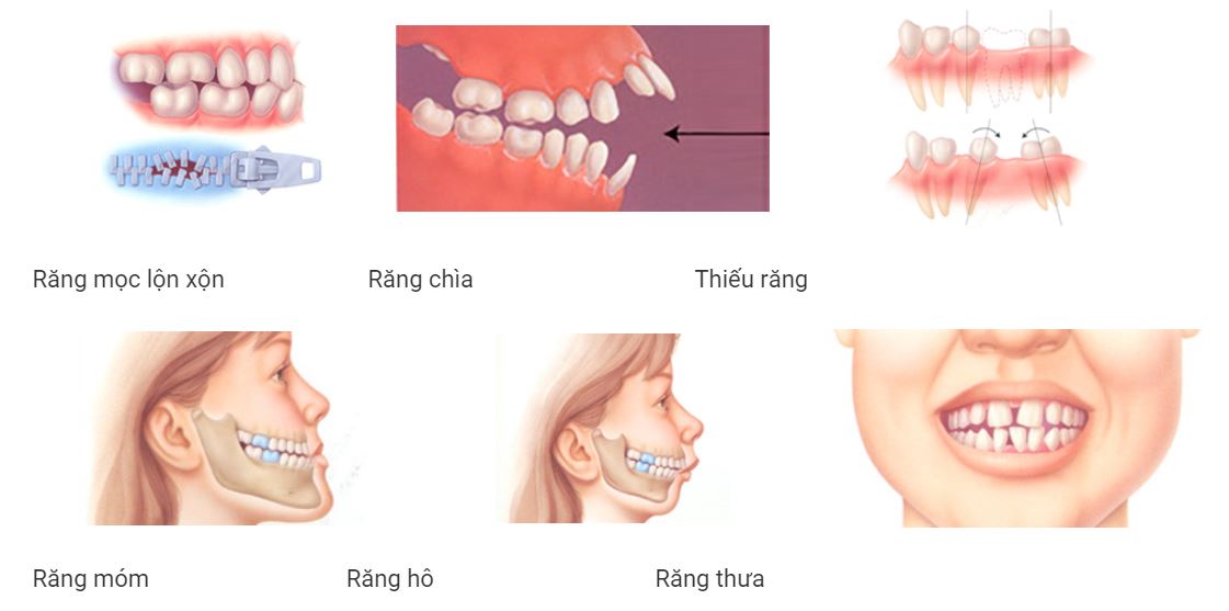 cac phuong phap chinh nha nien rang nieng rang mac cai tot nhat tai nha khoa hoang yen dental 1111