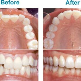 cac phuong phap chinh nha nien rang nieng rang mac cai tot nhat tai nha khoa hoang yen dental 9999