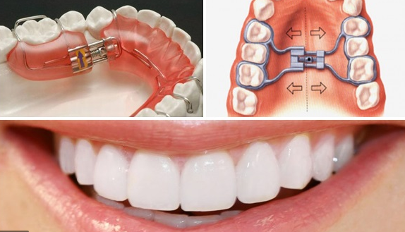 chinh nha nien rang tot nhat o nha khoa hoang yen dental clinic