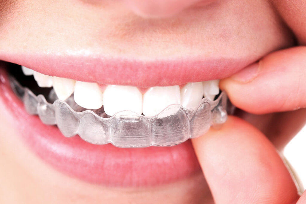 chinh nha nien rang tot nhat o nha khoa hoang yen dental18