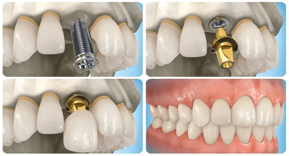 quy trinh cay ghep implant nha khoa hoang yen dental