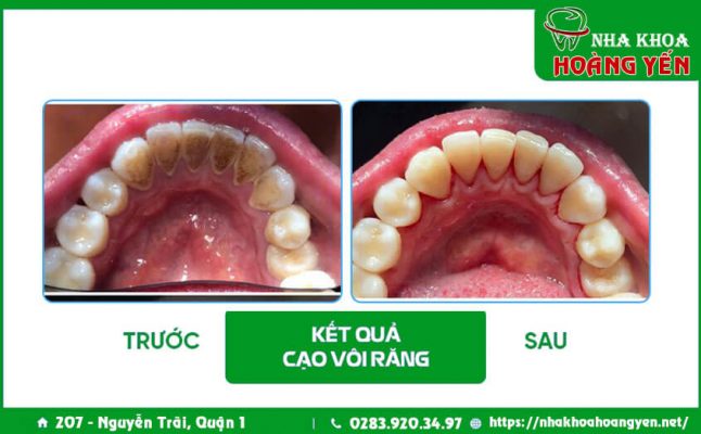 cao-voi-rang-lay-voi-rang-nha-khoa-hoang-yen-1