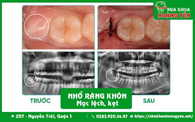Nho-rang-khon-tai--quan-1-nha-khoa-hoang-yen-quan-1-bs-cuong